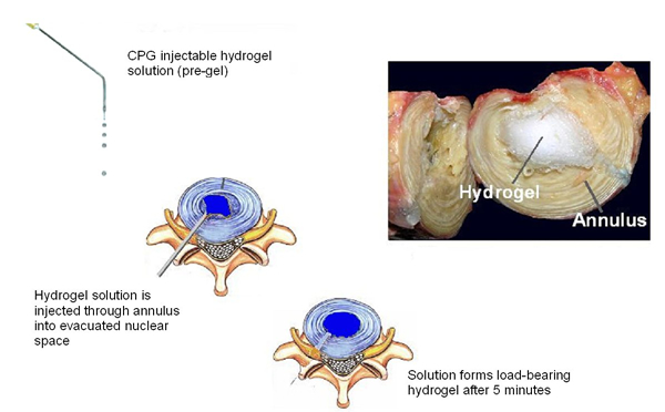 Schematic Diagram of Nucleus Pulposus Replacement with an Injectable Hydrogel Schematic Diagram of Nucleus Pulposus Replacement with an Injectable Hydrogel