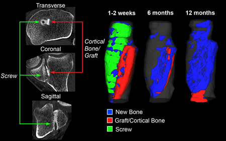 Assessing Longitudinal Bone Growth and Implant Resorption with CT Assessing Longitudinal Bone Growth and Implant Resorption with CT