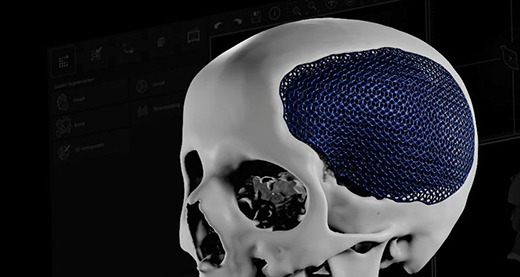 Materialise Personalized Implant