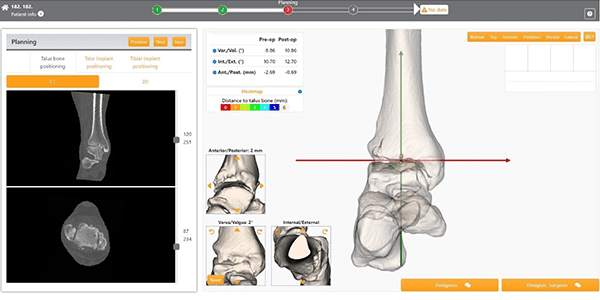 3D-Side Ankle Replacement Planning Software