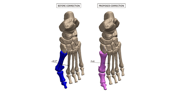 RedPoint Medical 3D Better Bunion System