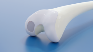 BioPoly Knee System