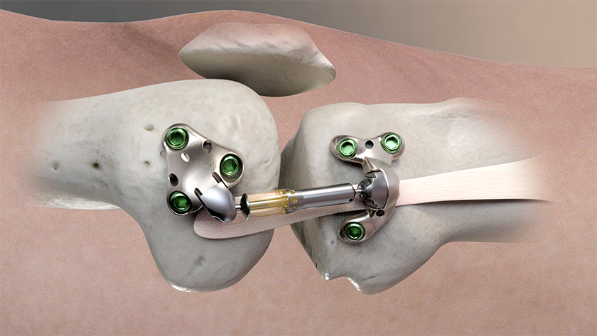 Moximed MISHA Knee implantable shock absorber