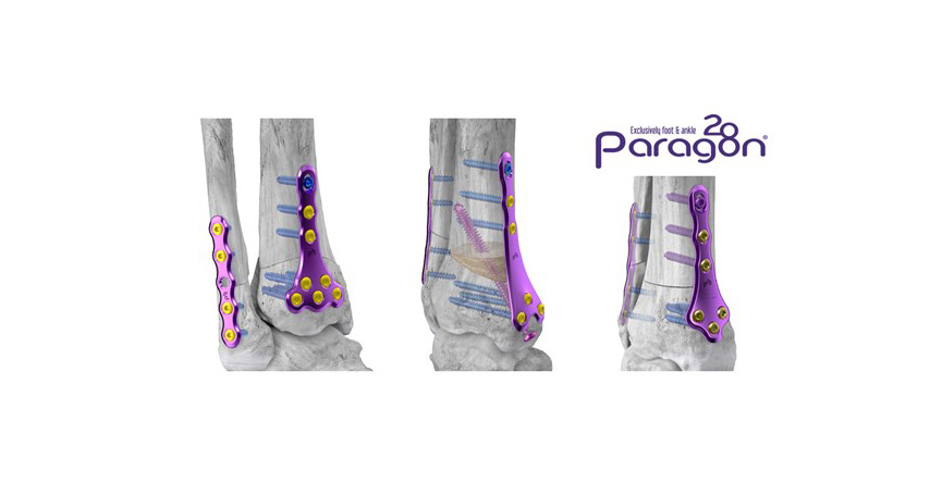 Paragon 28 Supramalleolar Osteotomy System