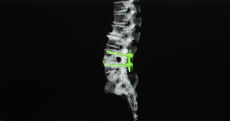 interbody spinal fusion implants