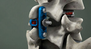 Wenzel Spine primaLOK SP