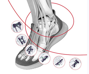 DePuy Synthes TriLEAP Lower Extremity Anatomic Plating