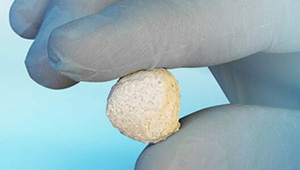 Bone Solutions Mg Osteocrete