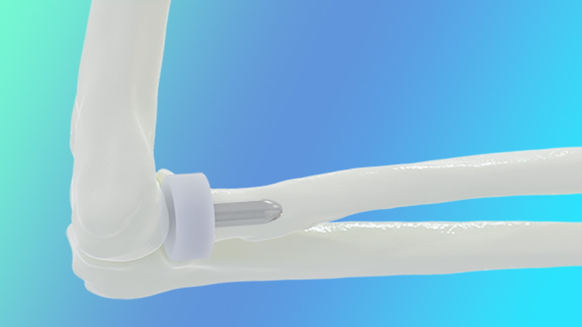 BioPoly Radial Head