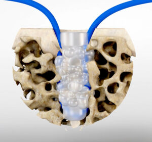 Surgical Fusion Technologies SF Push-in Anchor