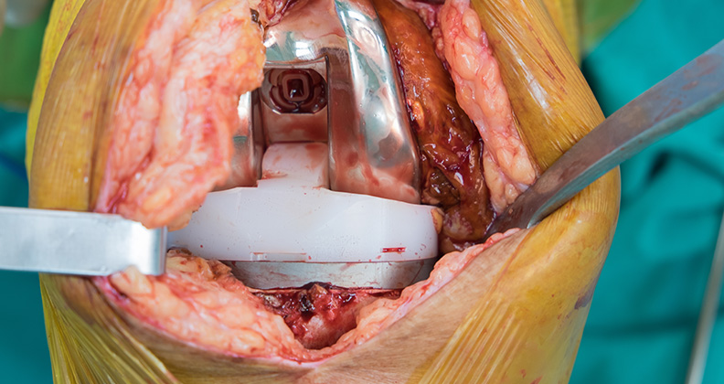 Large knee incision reveals joint replacement implant