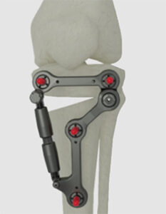 Response Ortho Solutions | Metaphyseal Hinge Fixator