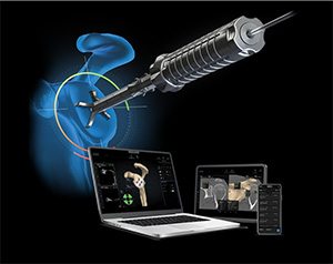 Arthrex | Virtual Implant Positioning (VIP) System Software 
