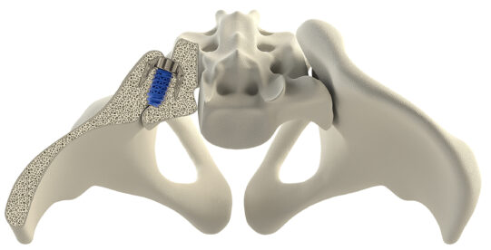 SurGenTec's TiLink-P implant Implant