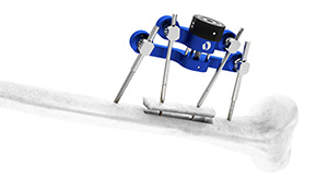 Orthofix TrueLok Elevate