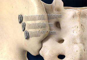Promethean Restorative | DYNAMIS SI Screw System