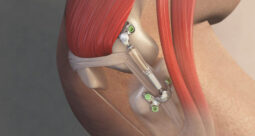 First Patients Treated in New Trial of MISHA Knee System