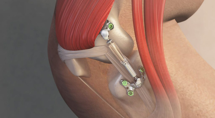 First Patients Treated in New Trial of MISHA Knee System