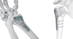 JNJ Medtech VOLT Wrist and Proximal Humerus Plating