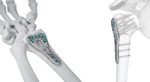 JNJ Medtech VOLT Wrist and Proximal Humerus Plating