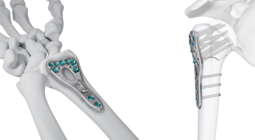 JNJ Medtech VOLT Wrist and Proximal Humerus Plating