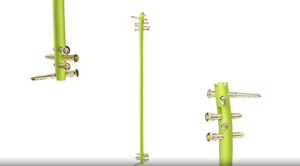 Smith+Nephew TRIGEN MAX Tibial Nail