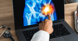 Zimmer Biomet Gains PMDA Approval of Iodine-Treated Total Hip Replacement