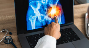 Zimmer Biomet Gains PMDA Approval of Iodine-Treated Total Hip Replacement