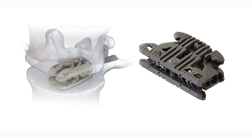 Accelus Spine Implants