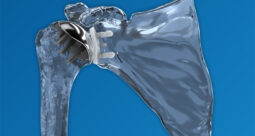 Catalyst OrthoScience Catalyst CSR Shoulder
