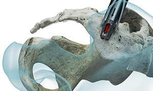 Wenzel Spine panaSIa SI Fusion