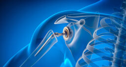 Stock photo graphic showing the bones of a shoulder joint and an implant