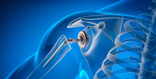 Stock photo graphic showing the bones of a shoulder joint and an implant