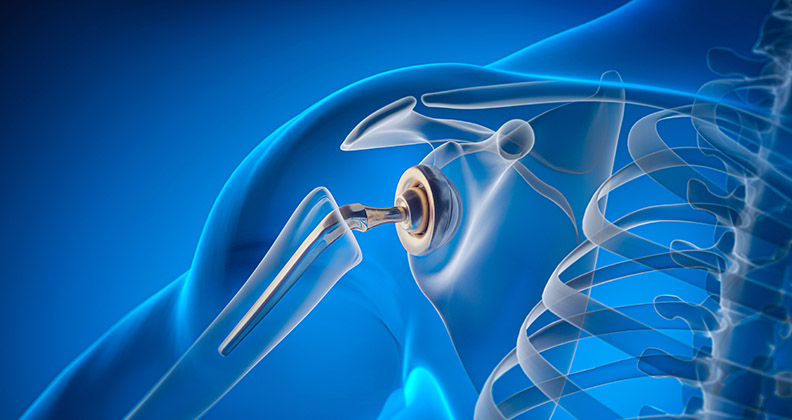 Stock photo graphic showing the bones of a shoulder joint and an implant