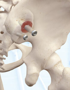 SiVantage Simmetry Implant