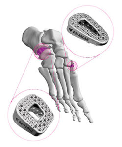 Auxano Medical ARKEO Wedge