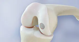 Biopoly's Knee resurfacing implant
