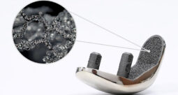 A partial knee implant with Biofuse 3D-Printed Lattice Structure