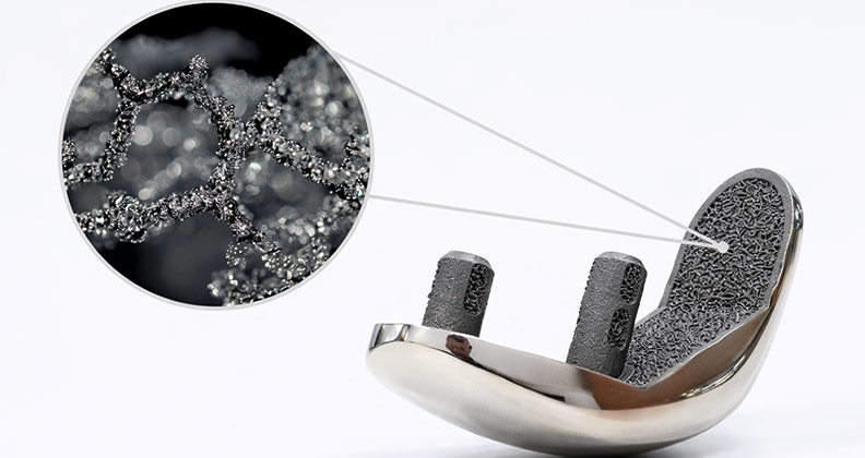 A partial knee implant with Biofuse 3D-Printed Lattice Structure