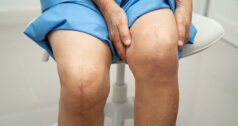 Straight forward shot of a knee replacement patient holding their knee with scars showing