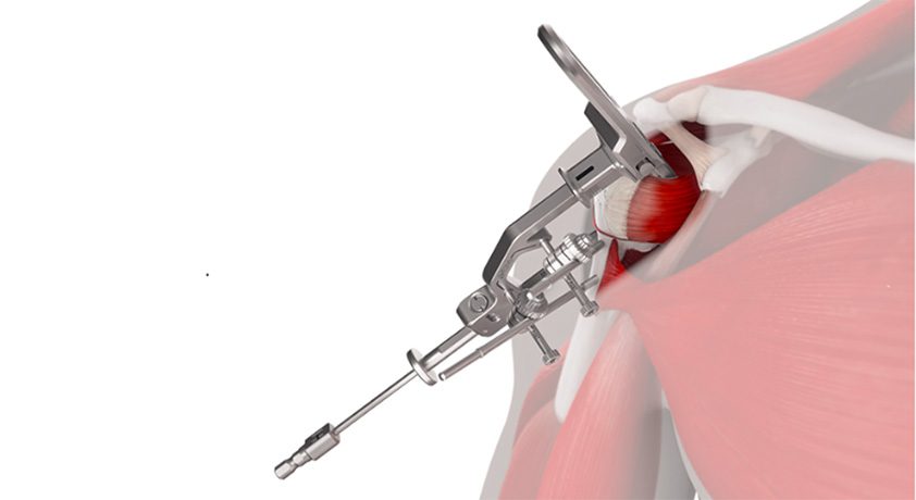 J&J MedTech's Inhance Intact 