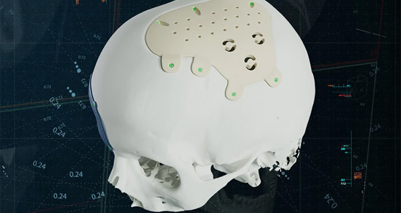 Materialise Custom-made PEEK Implants