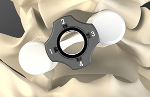 Allevion Medical's Vantage Device