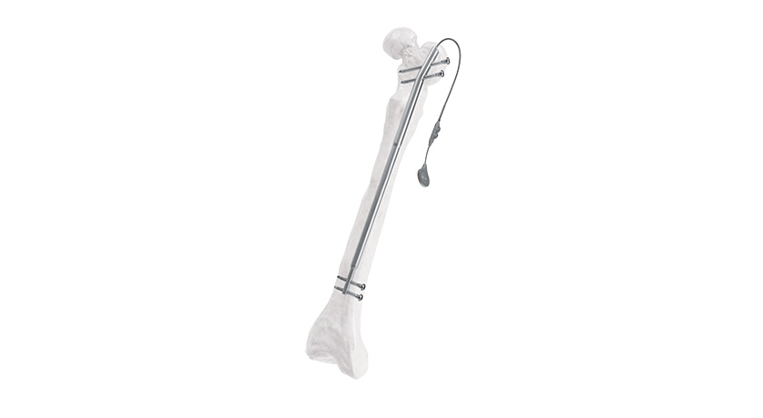 Orthofix Medical Fitbone Trochanteric Lengthening System