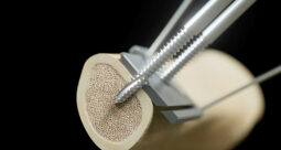 BlueOcean Global’s Excelsior External Fixation