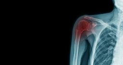 Shoulder x-ray with the joint highlighted in red