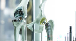 hip and knee replacement implants